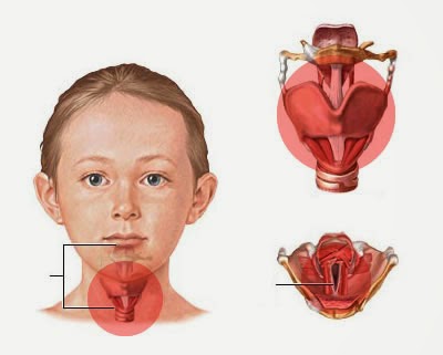 laringitis en niños