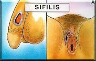 Obat Sipilis Bagi Wanita