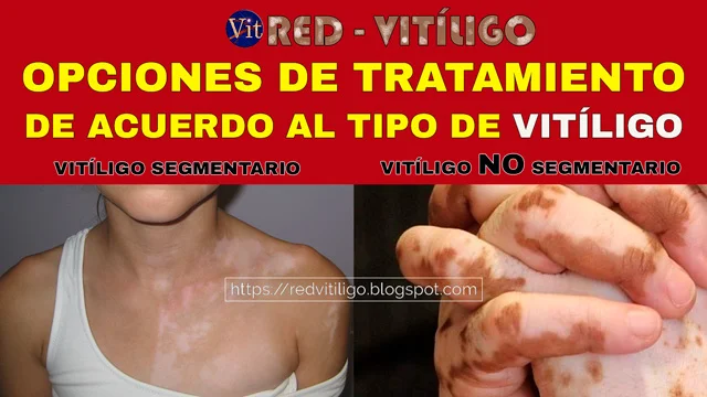 Opciones de tratamiento para el vitiligo