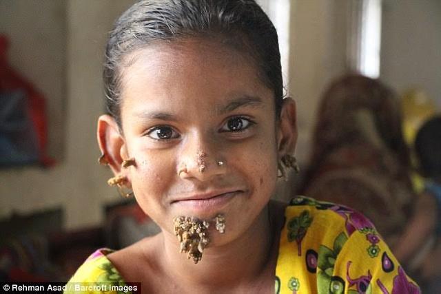 Sahana, asal Bangladesh yang terkena sindrom manusia pohon