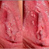 Beli obat kutil kelamin untuk pria dan wanita thumbnail