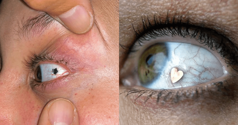 People Are Getting Their Eyeballs Pierced, And It Looks Painful