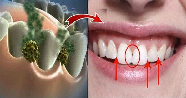 INILAH Cara Ampuh Hilangkan Bau Mulut dan Semua Bakteri dalam 5 Menit