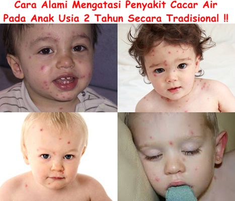 Obat Cacar Air Tradisional Untuk Anak 2 Tahun