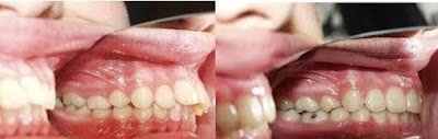 Nguyên nhân tại sao răng lại vổ