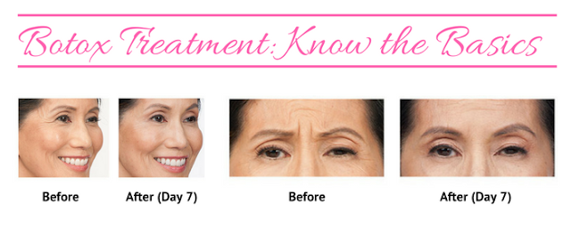  Botox Treatment: Know the Basics