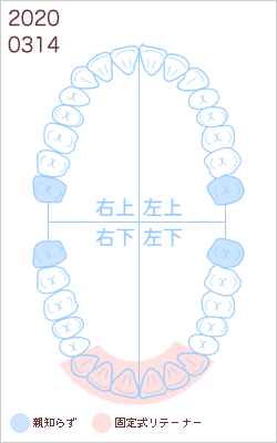 歯列矯正：定期検診その46