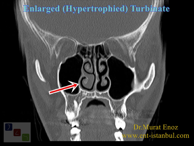 Causes of Turbinate Hypertrophy,Enlarged Turbinates,Radiofrequency turbinate reduction,Coblation Turbinate Reduction,Hypertrophied Turbinates