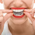 Kinh nghiệm niềng răng bằng khay invisalign