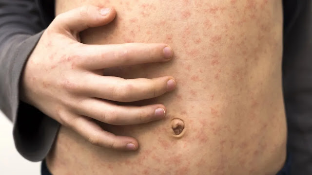 UK declares ‘national incident’ over measles outbreak