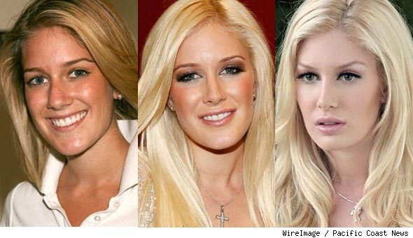 heidi montag before and after. heidi montag before and after