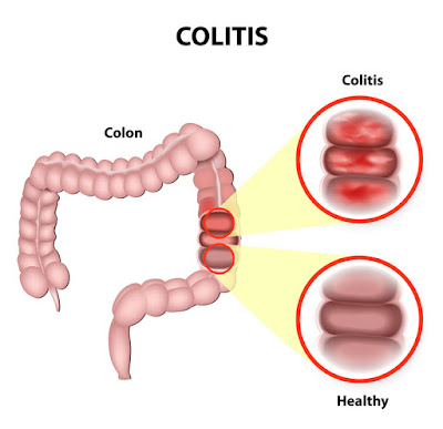 http://surgicalgastro.com/ulcerative-colitis/