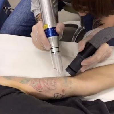 Jessica Origliasso of The Veronicas Undergoes Laser Removal