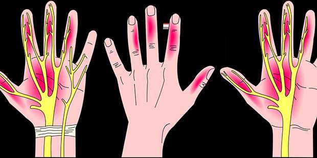 تأثير متلازمة النفق الرسغي في اليد