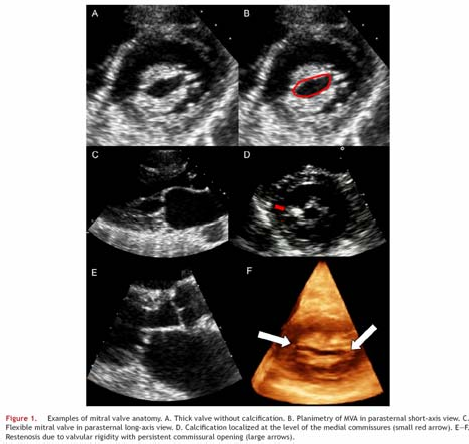 Mitral Valve anatomy parasternal long-axis view calcification commissures mitral stenosis