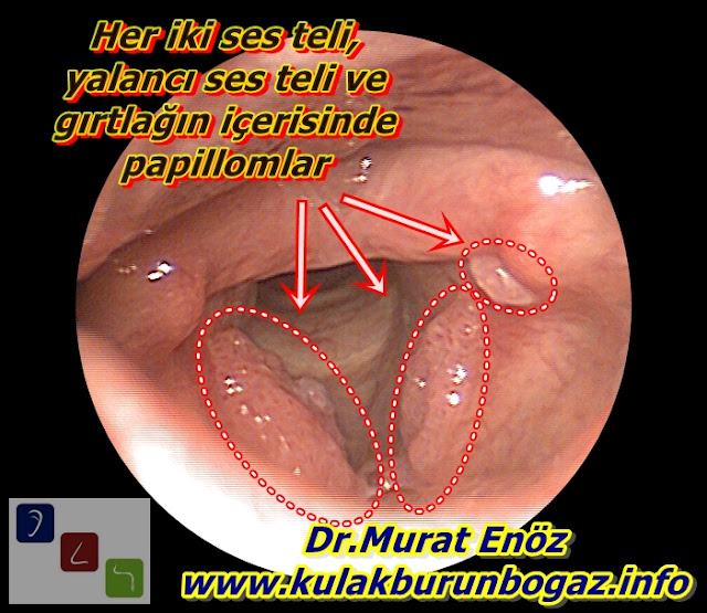 Vocal Cord Papillomatosis - Common Papillomatosis of the Larynx