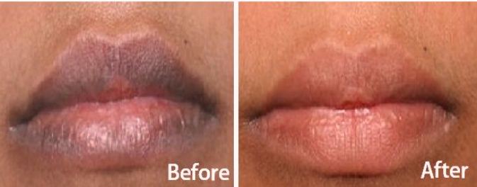 In order to remove the dead skin cells form your lips and make them 