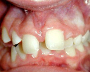 Phương pháp khắc phụ khi răng bị lệch lạc