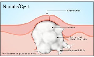 Nodular Acne and Cystic Acne