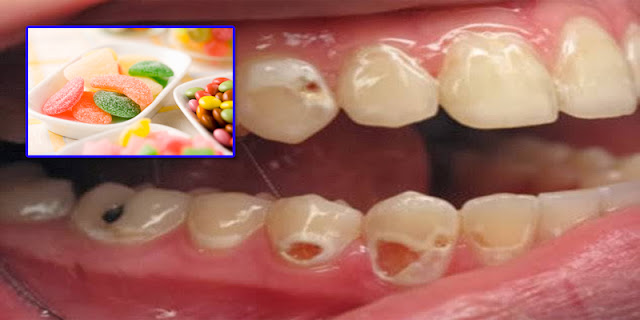 Dental health, Oral hygiene, Tooth decay prevention, Enamel protection, Healthy diet for teeth, Foods for strong teeth, Avoiding sugary snacks, Acidic food impact, Dental care habits, Nutrition and oral health