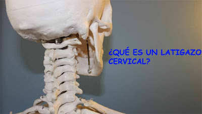 que es un latigazo cervical