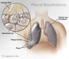 Treatment of Mesothelioma