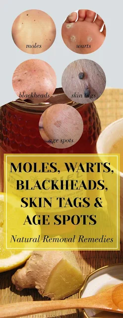 Moles, Warts, Blackheads, Skin Tags And Age Spots – Natural Removal Remedies