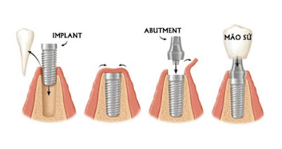 Implant nha khoa là gì?