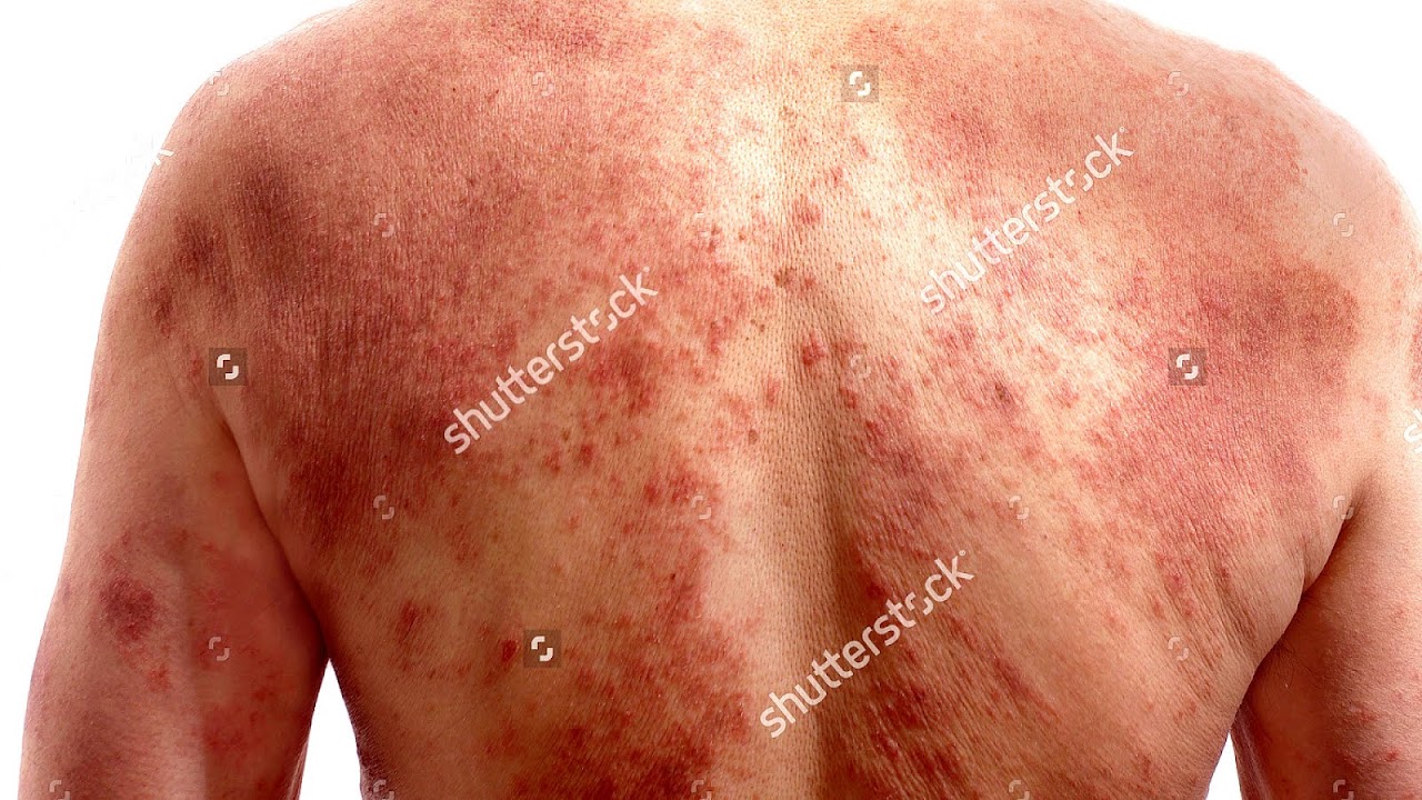 African American Skin Rashes