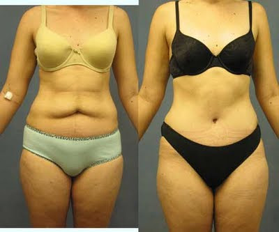 abdominoplasty