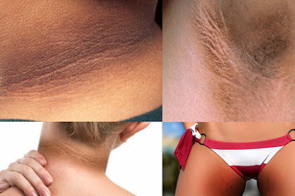 Remove Those Annoying Dark Patches On The Neck, Underarms And Inner Thighs In 15 Minutes!