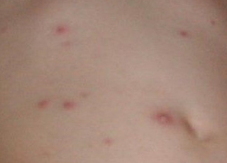 early chicken pox pictures