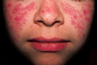 Systemic lupus erythematosus