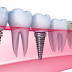 Trồng răng Implant ở đâu tốt?