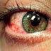 ¿Qué Son las Alergias de los Ojos?