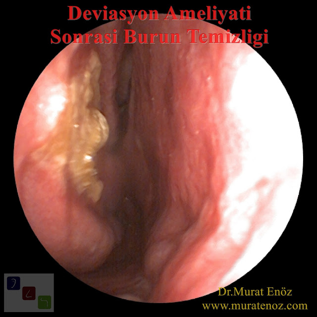 Septoplasti ameliyatı sonrası burun temizliği - Deviasyon ameliyatı sonrası burun temizliği - Burun kıkırdak eğriliği ameliyatı sonrası burun temizliği - Deviasyon ameliyatı sonrası dikkat edilmesi gerekenler - Nazal septum deviasyonu ameliyatı sonrası bakım - Burun deviasyon ameliyatı sonrası iyileşme süreci - Ameliyat sonrası burun tıkanıklığı - Burun ameliyatı sonrası burun tıkanıklığı nasıl geçer?