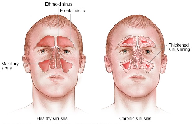 Cara Mujarab Mengobati Sinusitis Secara Alami Dengan Ramuan Air Garam