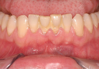Dấu hiệu và triệu chứng bệnh viêm chân răng-2