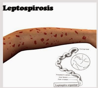 Penyakit Leptospirosis