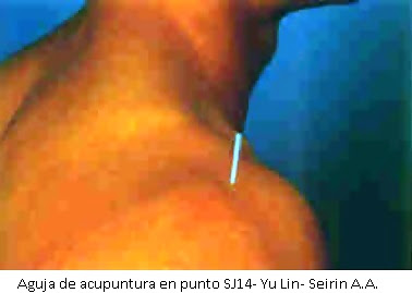 acupuntura en hombro doloroso - tendinitis