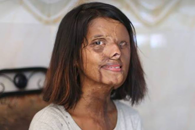 Acid attack girl story Assamese news