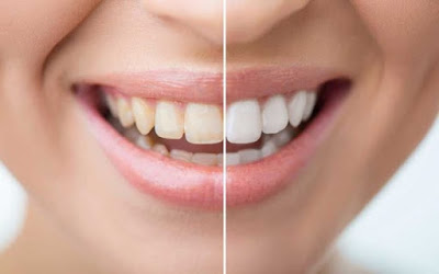 Ai nên thực hiện tẩy trắng răng? 