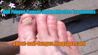 Nail Fungus Causes and Ineffective Treatments