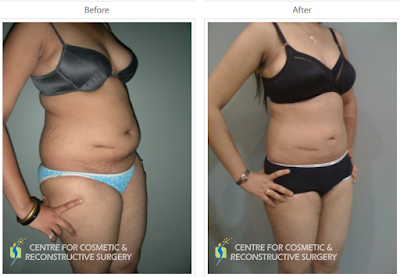 Liposuction in Mumbai