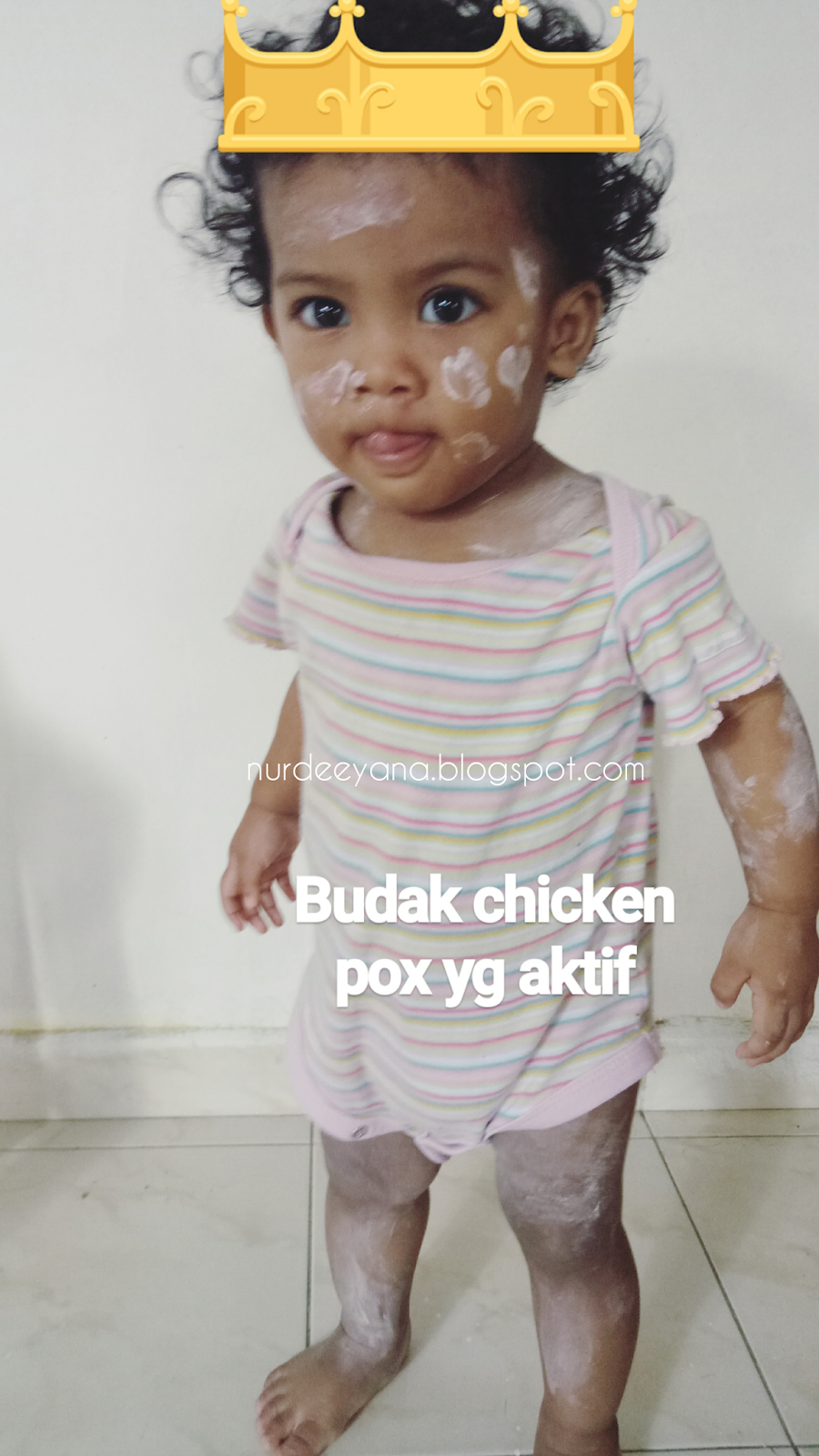 Nurdeeyana.blogspot.com: Chicken Pox (Part 2)
