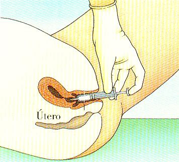 Inseminação Artificial