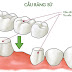 Cầu răng sứ có hiệu quả không?