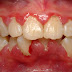 Dấu hiệu của bệnh viêm chân răng có mủ