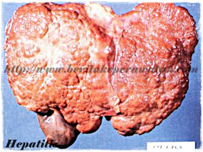 Cara Mengetahui Seseorang Menderita Penyakit Hepatitis