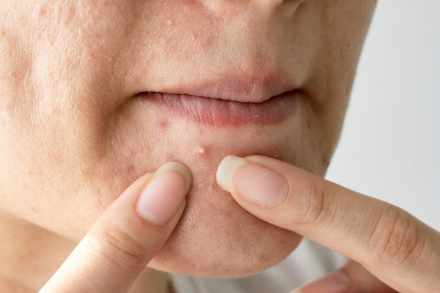 Acné juvenil, Tratamiento para el acné hormonal, Cómo prevenir cicatrices de acné, Remedios caseros para el acné, Piel grasa y poros obstruidos,